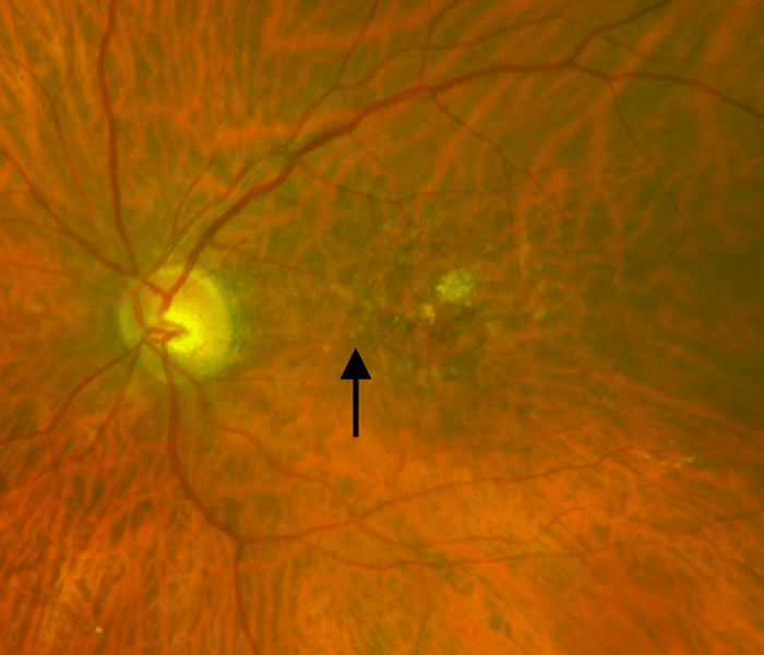 Dry Macular Degeneration